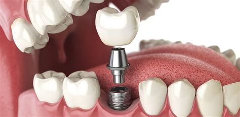 Implant Dentistry in New York | 209 NYC Dental