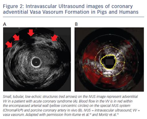 Viewpoint: Recent Advances in Intracoronary Imaging for Vasa Vasorum ...