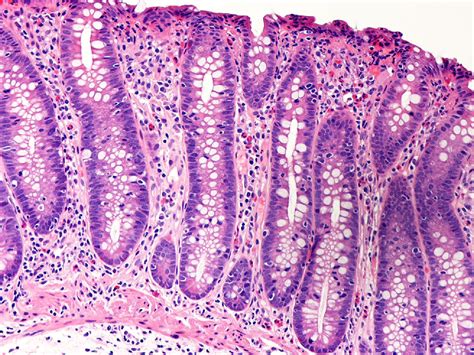 Microscopic Colitis - Gastroenterology