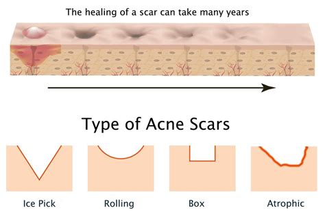 Acne scars treatment | Clinique spécialisée à Hull, Gatineau, Ottawa