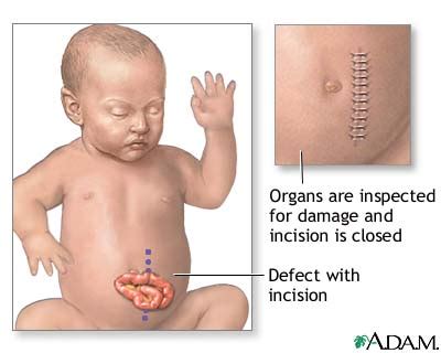 Gastroschisis repair - series—Procedure: MedlinePlus Medical Encyclopedia