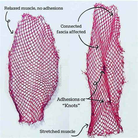 What is Fascia? - Mount Lawley Physiotherapy