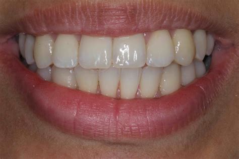 Porcelain Veneers or Braces? Make the Right Choice