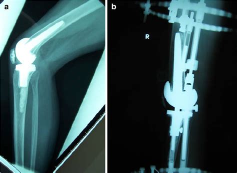 (a) Persistent knee flexion contracture after total knee replacement ...