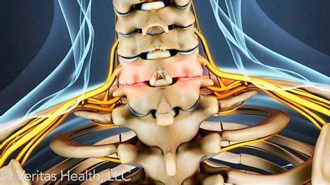 The facet joints of the cervical spine can degenerate just like the ...