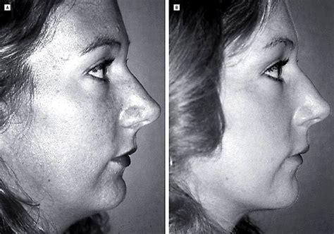 Evaluation and Treatment of Vertical Microgenia | Archives of Facial ...