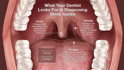 Montrose Sleep Apnea Dentist | Verdugo Hills Dental Group