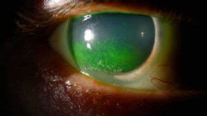 Keratoconjunctivitis sicca, causes, symptoms, diagnosis, treatment & prognosis