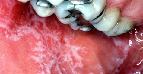 ORAL MEDICINE : Smokeless Tobacco Lesions - Directorio Odontológico