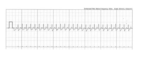 Worsening episodes of palpitations triggers a management review | New ...