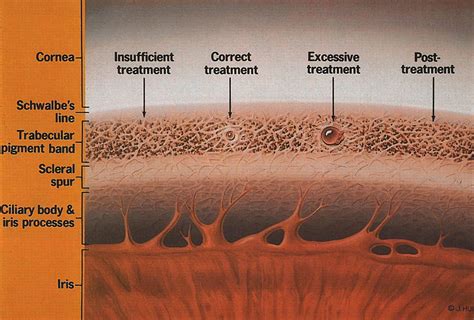 Argon laser applications to trabecular meshwork - American Academy of ...