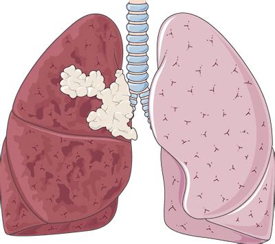 Pictures of Lungs After Quit Smoking & How We Can Help