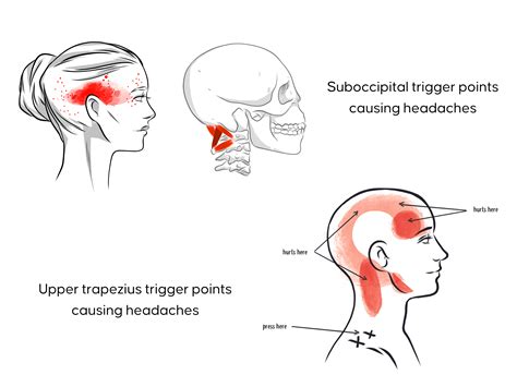 Tightness at the base of the skull? Massage these muscles