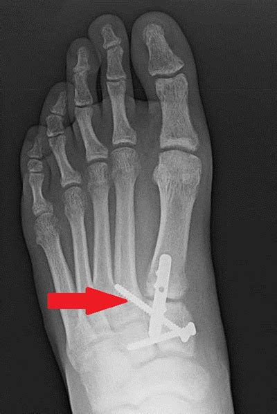 Lisfranc Surgery Procedure & Recovery