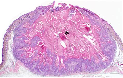 Keratoacanthoma Histology