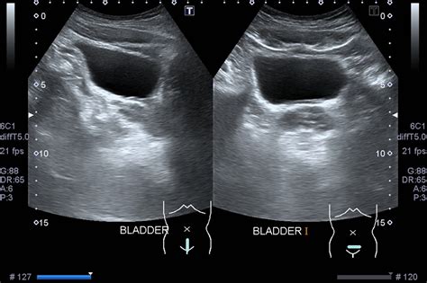 Ultrasound Bladder Scan in Singapore - AARE Urocare | Dr Fiona