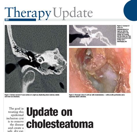 Middle Ear Cholesteatoma Surgery