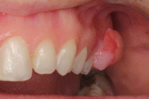 Common Symptoms of Gingival Hyperplasia | rockville-all-smiles-dentistry