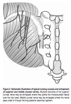 Accurate Education - Low Back Pain: Superior Cluneal Nerve Entrapment ...