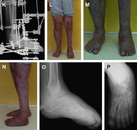 Case 2. ( A–E ) Preoperative views and radiographs of an equinovarus... | Download Scientific ...