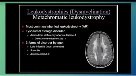 Metachromatic Leukodystrophy