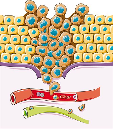 Cancerous cell - Servier Medical Art