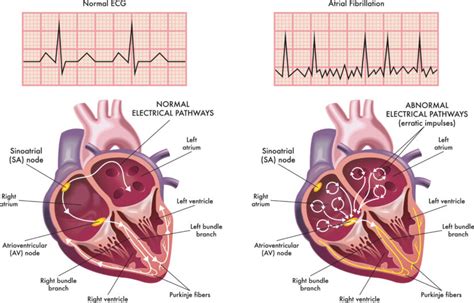 Atrial Fibrillation - Cause, Symptoms, Complications & Treatment in ...