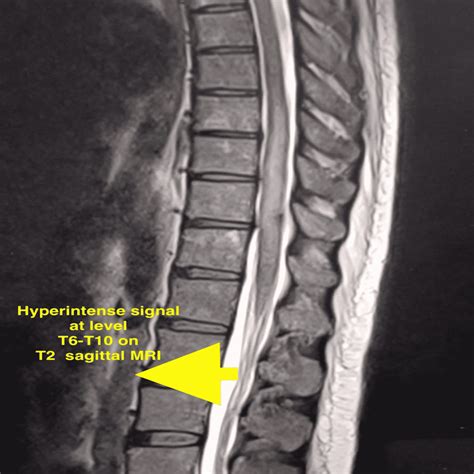 Cureus | Acute Transverse Myelitis in Pregnancy: The Use of ProSeal Laryngeal Mask Airway ...