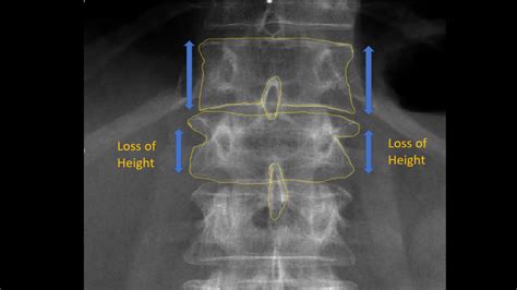 Lumbar X-ray Interpretation - OSCE Guide | Radiology | Geeky Medics