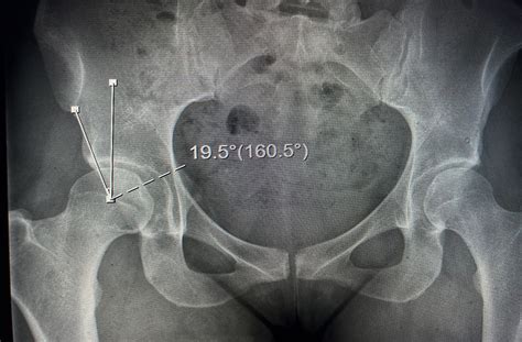 Treating Hip Dysplasia-Associated Labral Tears - BroadcastMed