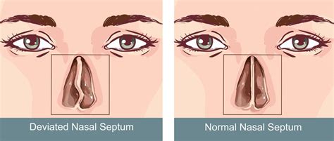 Nasal Septal Perforation Repair : Overview, Causes, Symptoms, Treatment - illness.com