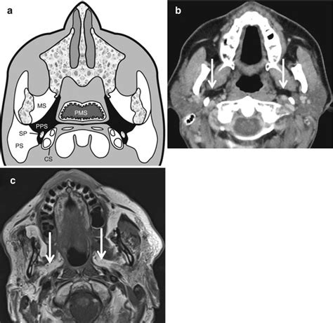 Spaces of the Neck | Radiology Key