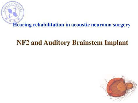 PPT - Acoustic neuroma surgery —Shanghai experience PowerPoint ...