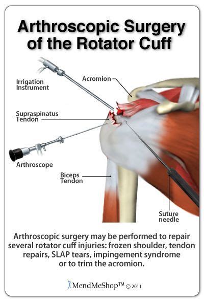 Arthroscopic surgery for a supraspinatus tendon rotator cuff tear. # ...