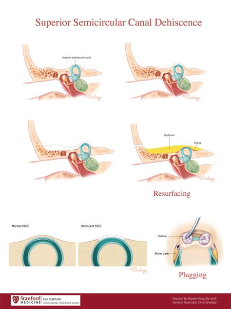 Appendix: Educational Handouts for Patients – Oto Surgery Atlas