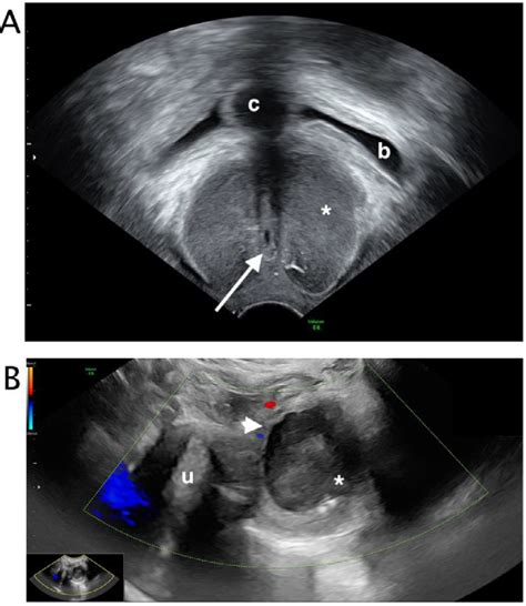 Figure 3 from Skene's glands abscess an overlooked diagnosis in acute ...