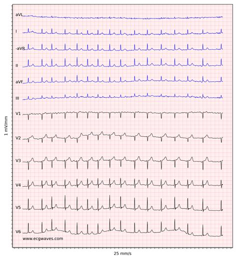 Atrial fibrillation: ECG, classification, causes, risk factors ...