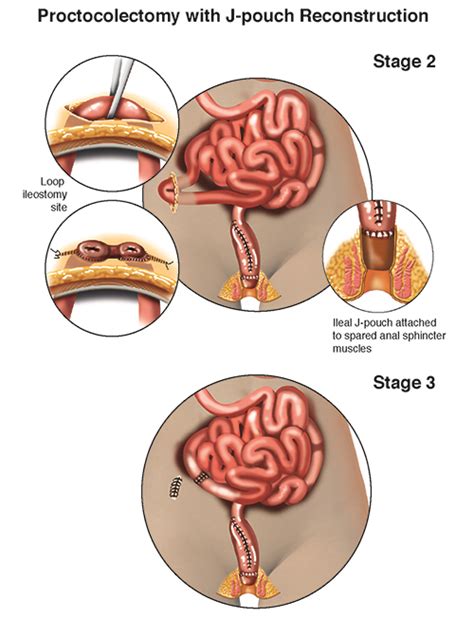 Total Proctocolectomy with J-pouch Reconstruction for Ulcerative ...