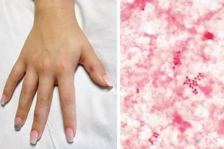 Woman develops gonorrhea rash on her hands and all over her skin - National | Globalnews.ca