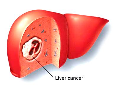 Cancer Treatment: Liver cancer treatment | the chances of survival