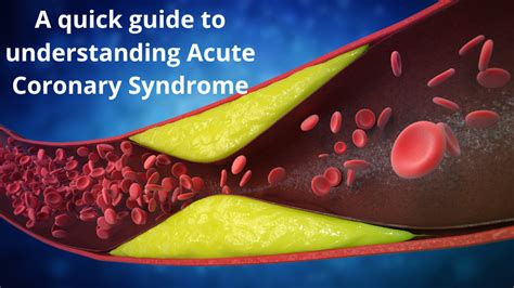 A quick guide to understanding Acute Coronary Syndrome – Clarity ...