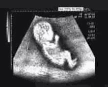 Funny Ultrasound Meme