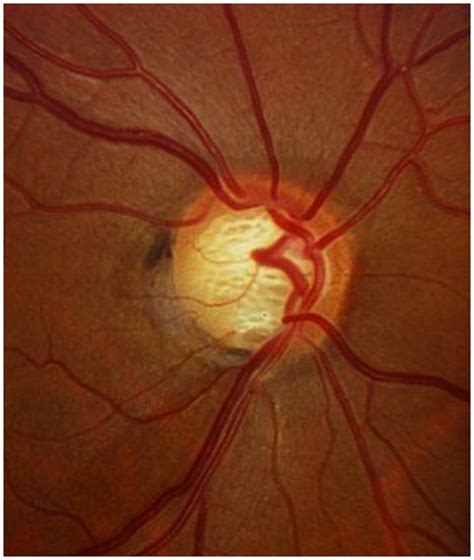 Pin en Glaucoma