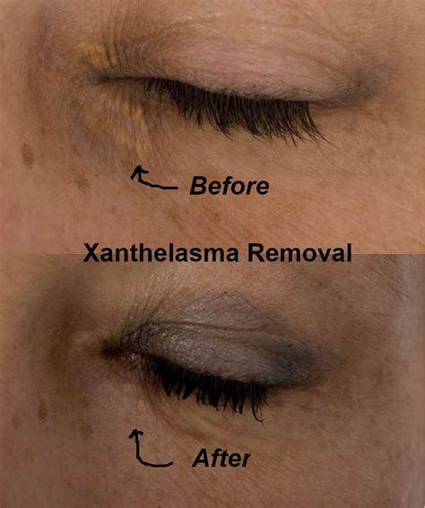 Xanthelasma Removal - Staiano Plastic Surgery