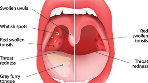 Can Sinus Drainage Cause Swollen Tonsils - Best Drain Photos Primagem.Org