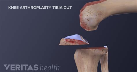 Total Knee Replacement Surgical Procedure