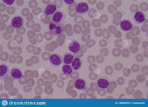 Moderatr Blast Cells on Red Blood Cell Background. Stock Image - Image of microscopic, hospital ...