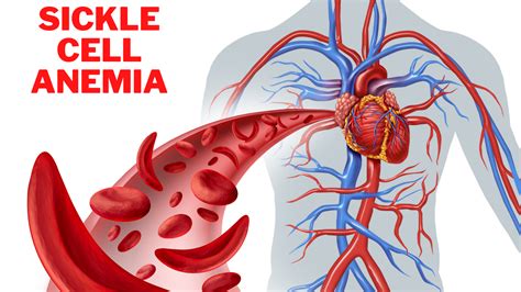 Ismail Successfully Underwent Bone Marrow Transplant In India