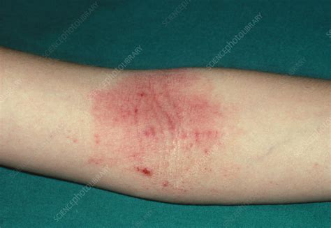 Atopic eczema on the inside of the elbow - Stock Image - M150/0082 - Science Photo Library