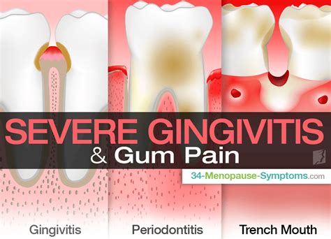 Severe Gingivitis & Gum Pain | Menopause Now